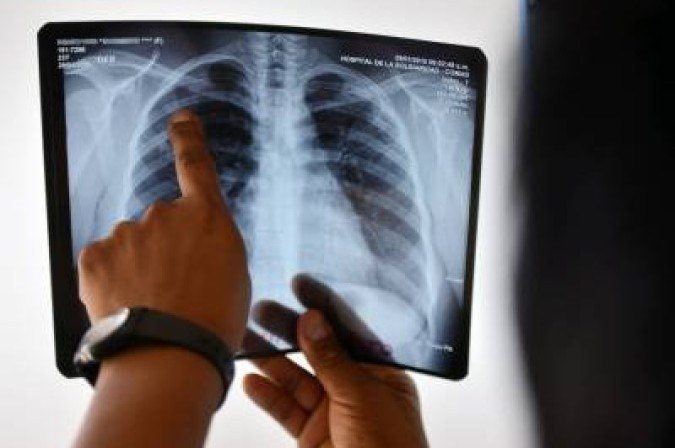 17-03 Ações de combate à Tuberculose2